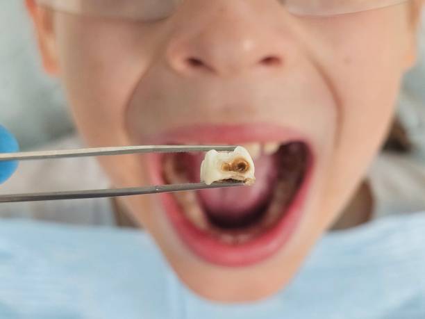 Best Emergency Tooth Extraction in Barrackville, WV